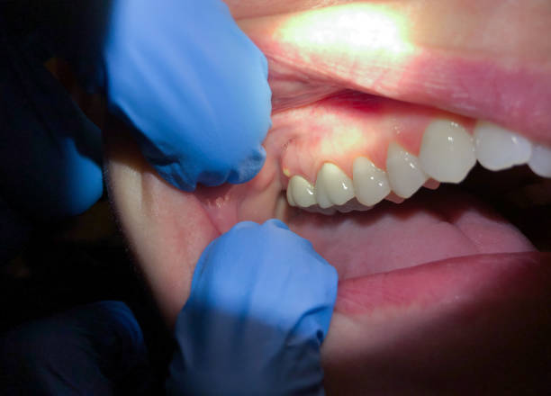 Best Dentist for Tooth Abscess  in Midland Park, NJ